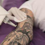 La eliminación de tatuajes en España crece un 30% entre los tratamientos de láser estético 26