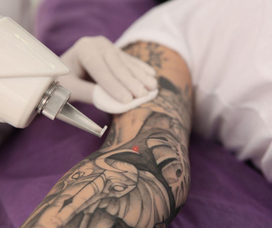 La eliminación de tatuajes en España crece un 30% entre los tratamientos de láser estético 14
